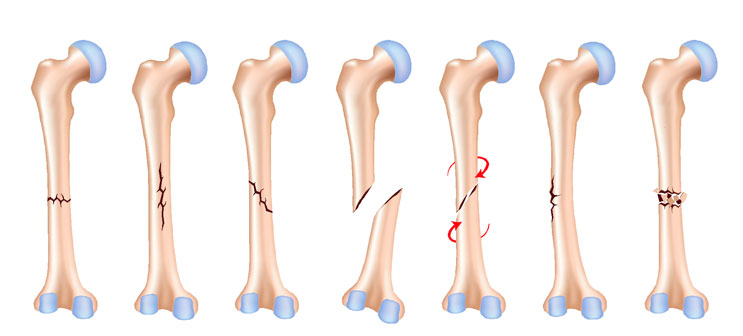 Виды переломов